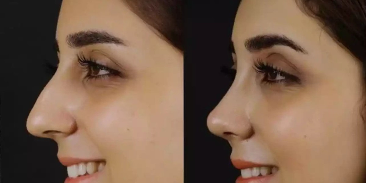 Top Signs You Might Need Septoplasty in Dubai
