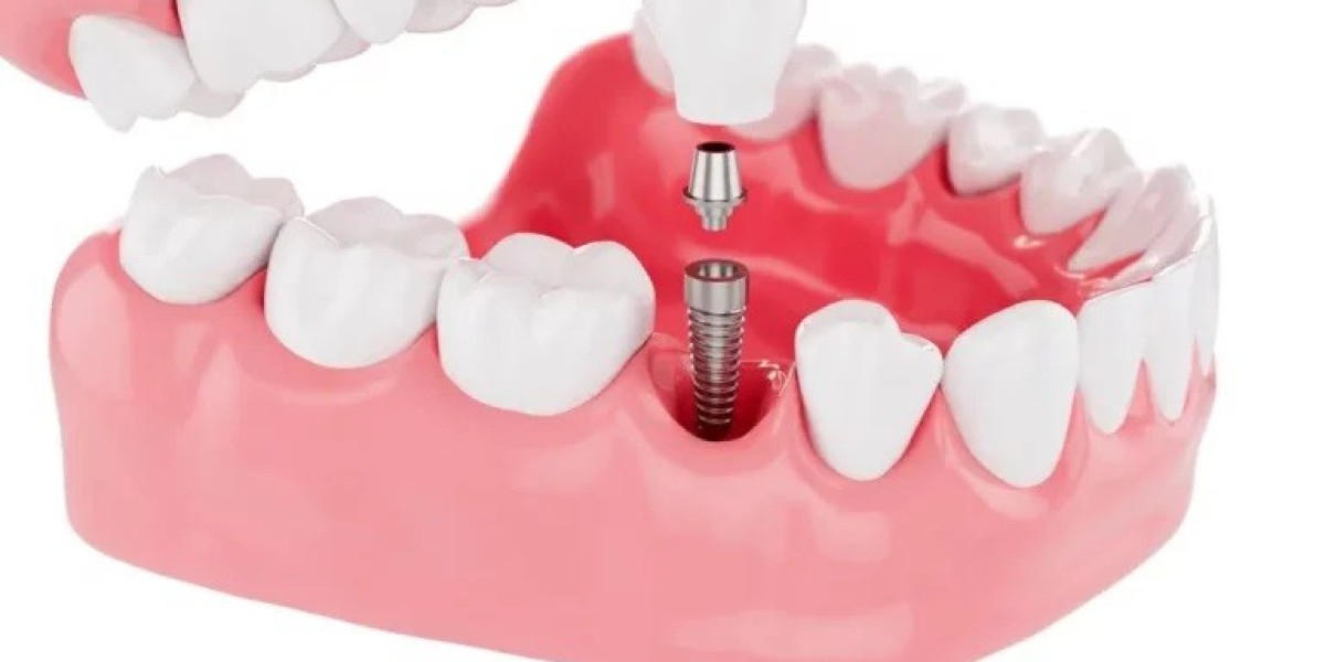 A Step-by-Step Guide to Getting Dental Implants in Brisbane