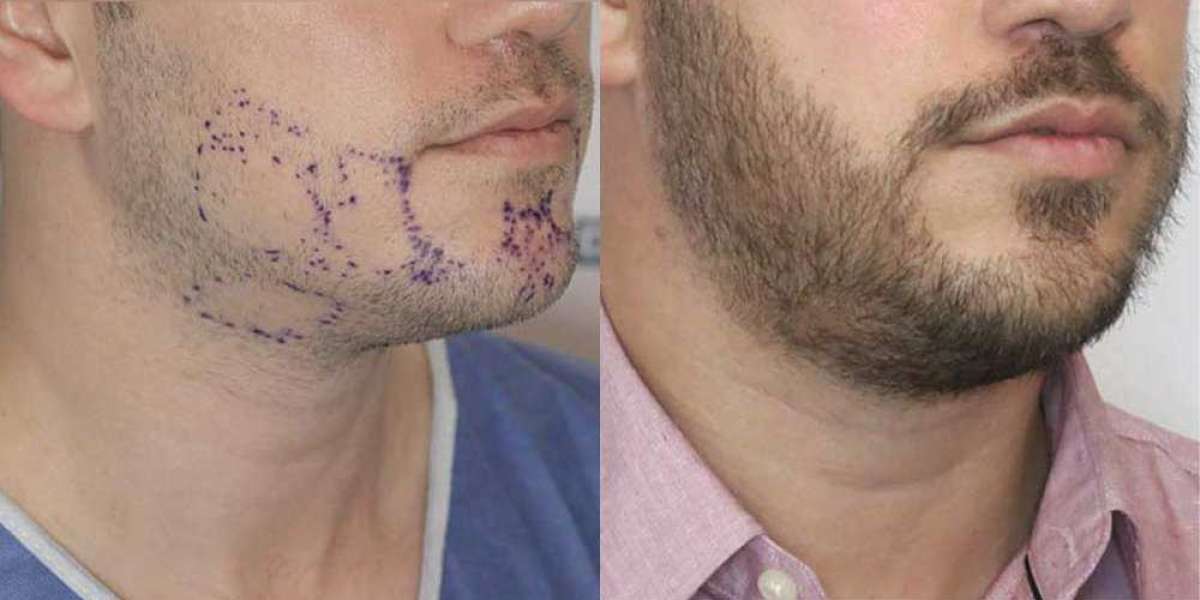 Implantación De Barba