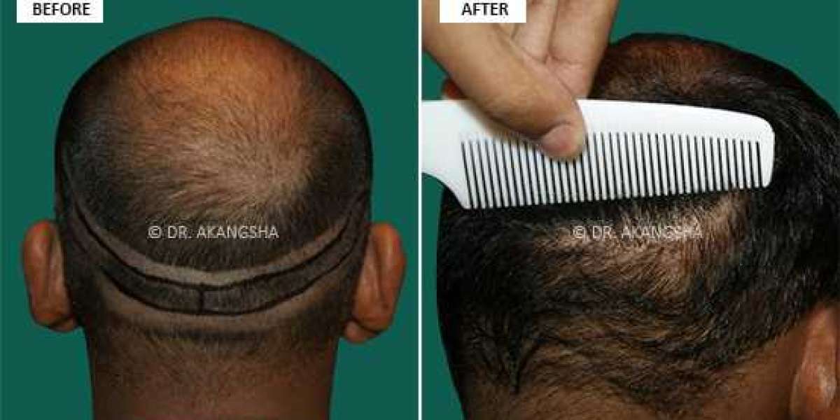 Dr. Akangsha Sharma, the best hair transplant surgeon in Jaipur