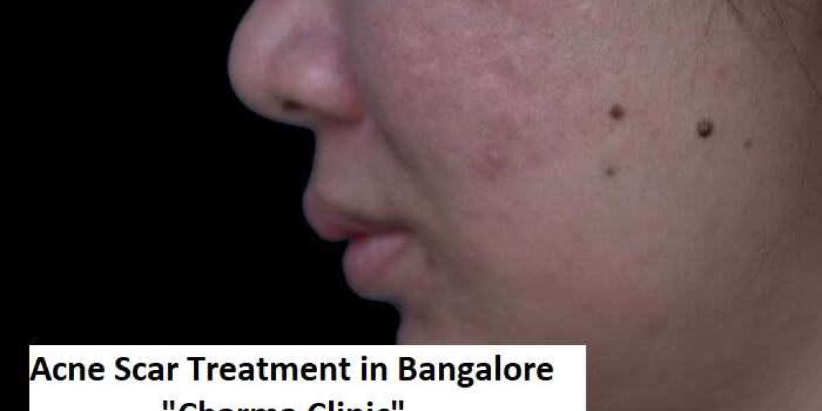 Get Acne Scar Treatment in Bangalore at Charma Clinic