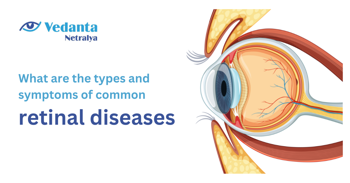 What are the types and symptoms of common retinal diseases? | by Vedanta Netralya | Jan, 2023 | Medium