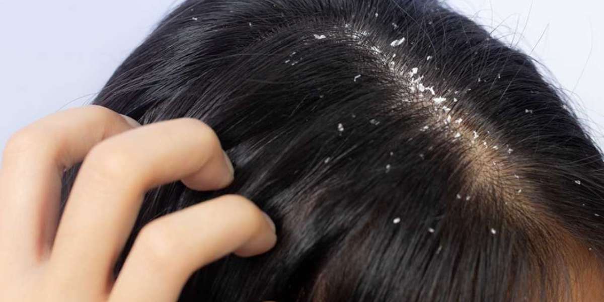 Effective Dandruff Treatment: How to Get Rid of Flakes for Good