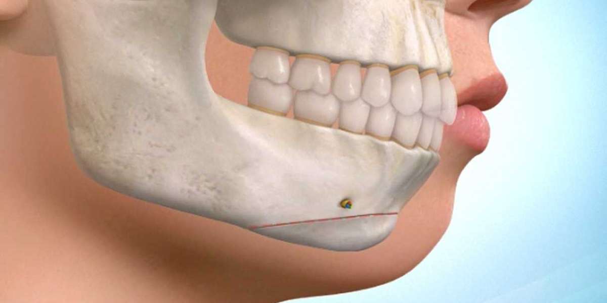 TMJ Implants Market Trends and Forecast 2022-2030 | Research Report covers Global Industry Size