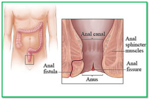 Homeopathic Medicine for Anal Fissure | Fissure Treatment in Homeopathy