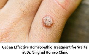 Homeopathic Treatment for Warts | Warts Homeopathy Medicine