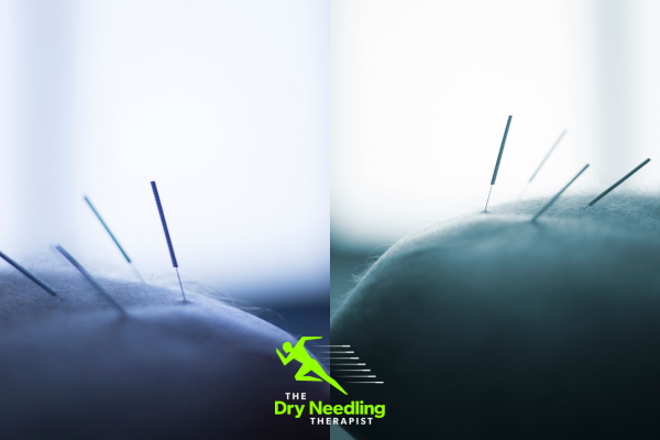Getting To Know the Most Proficient Dry Needling Therapy Centre – JE Care & Consultants