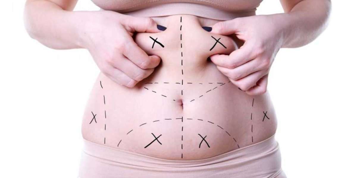 Trim Your Body Shape: A Comprehensive Guide to Liposuction Surgery in India