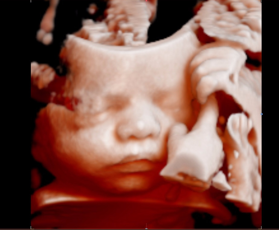 Premium Early Gender & 5D/4D/3D Baby Ultrasound - Price Beat Guarantee