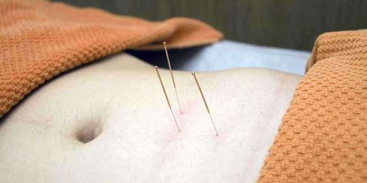 Looking for Acupuncture For Low Back Pain