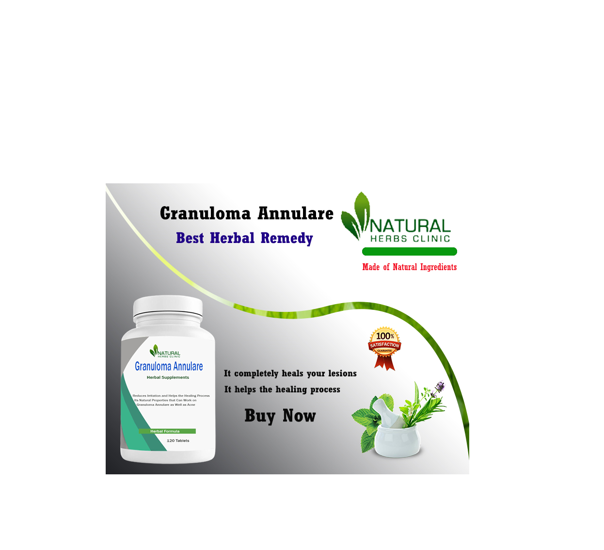 Home Remedies for Subcutaneous Granuloma Annulare Treatment Natural