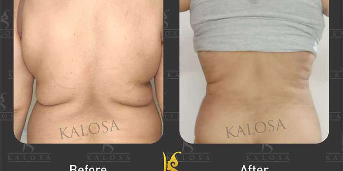 Sculpt Your Body with Liposuction Surgery
