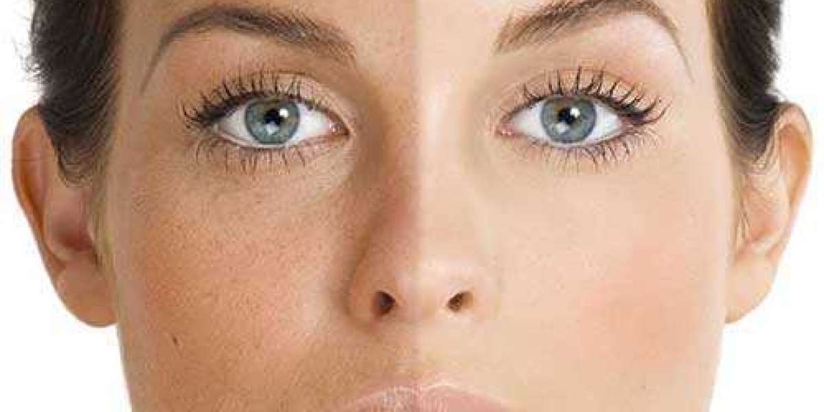 Skin Pigmentation: Understanding Causes, Treatment, and Prevention