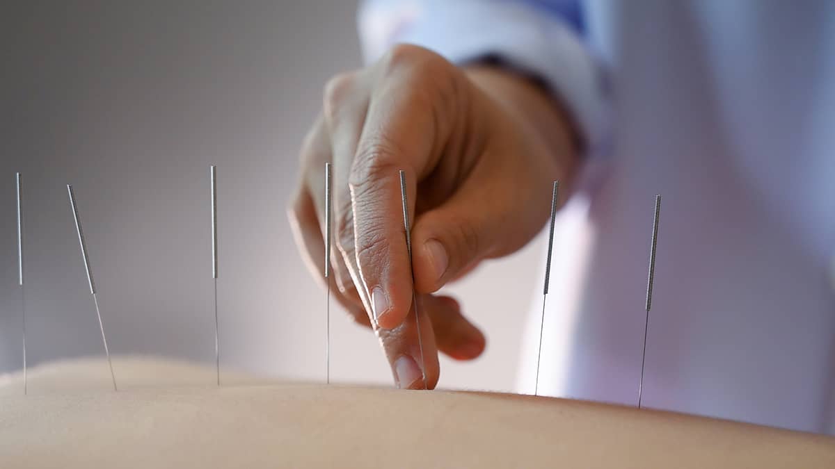 Acupuncture Pain Therapy in Bolton | Dial-A-PHYSIO