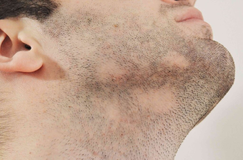 FUE Beard Transplant in London - Mittal Hair Clinic