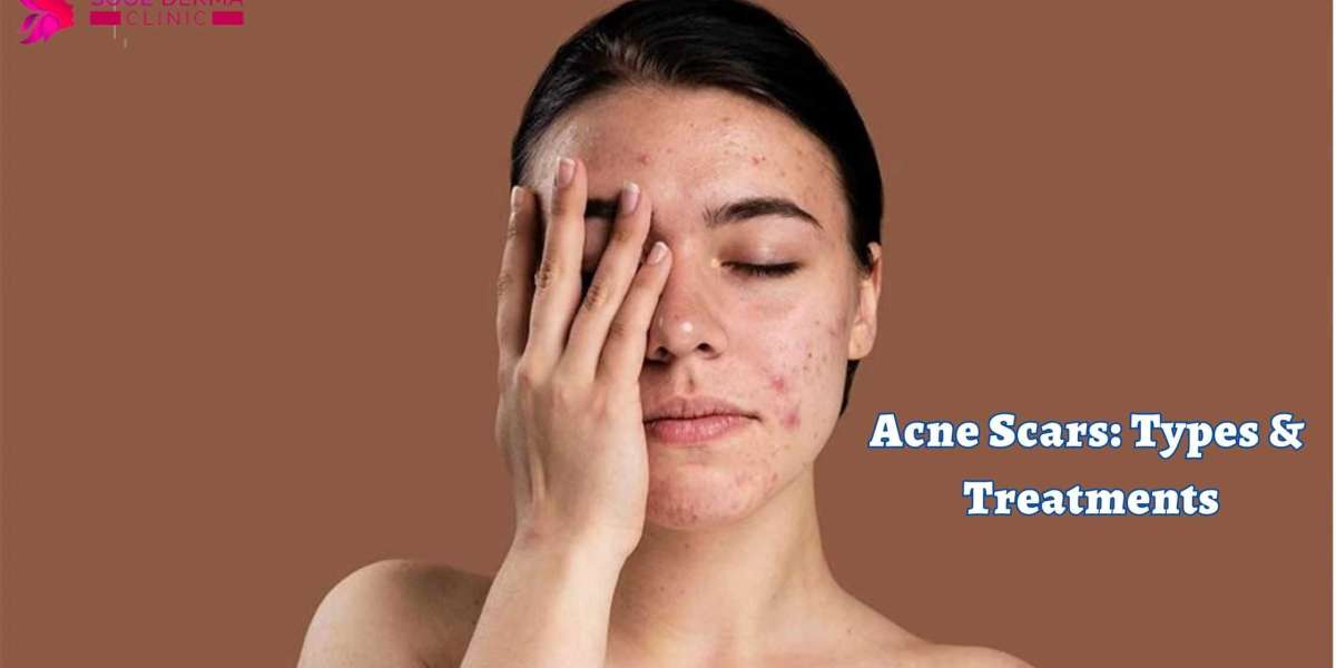 Acne Scars: Types & Treatments