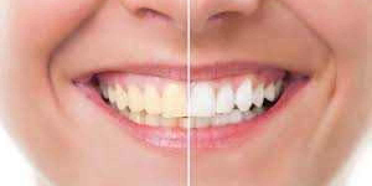 Achieving a Radiant Smile with Laser Teeth Whitening: An Advanced Dental Solution