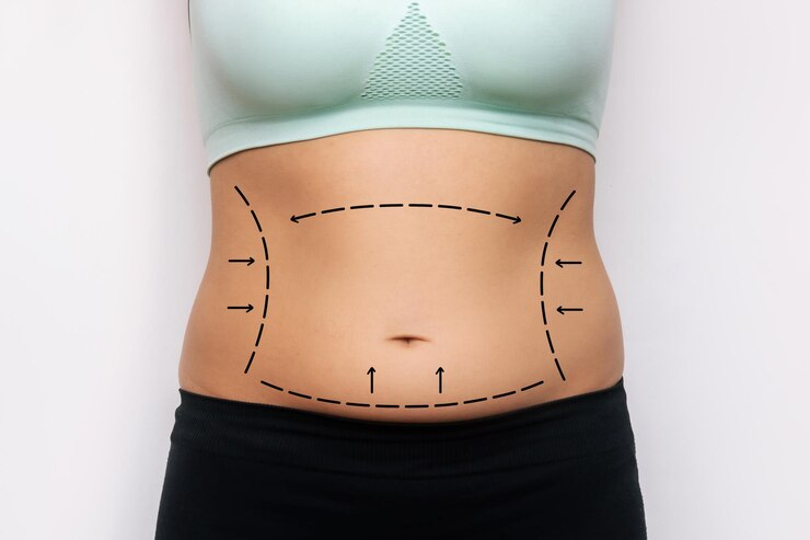 5 Things to do before a Tummy Tuck Surgery