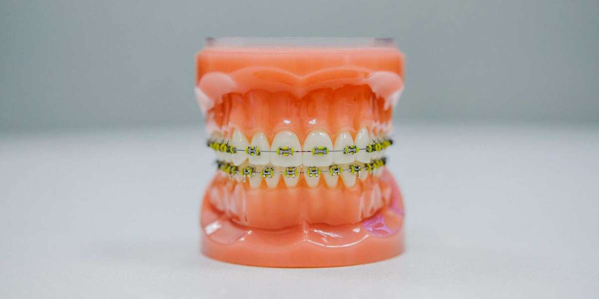 The Cost of Straightening Your Smile: Invisalign and Teeth Braces Prices in Pakistan