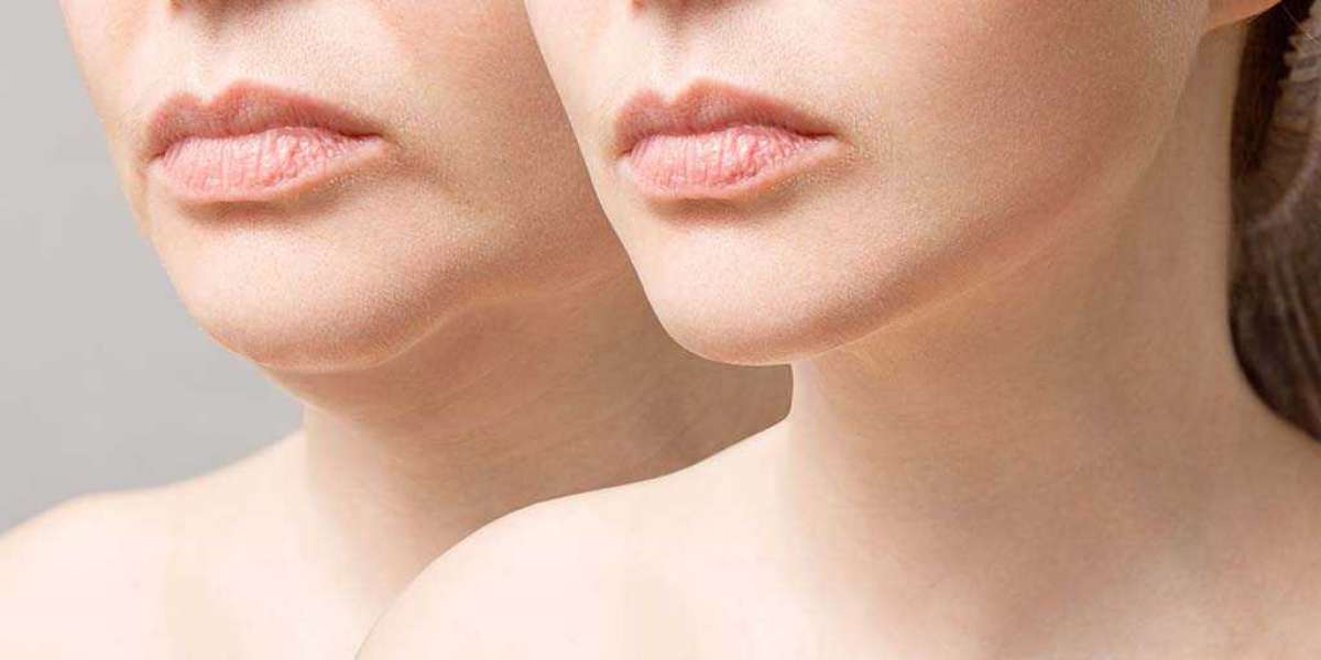 How Rhinoplasty Can Offer Relief from Sinus Problems