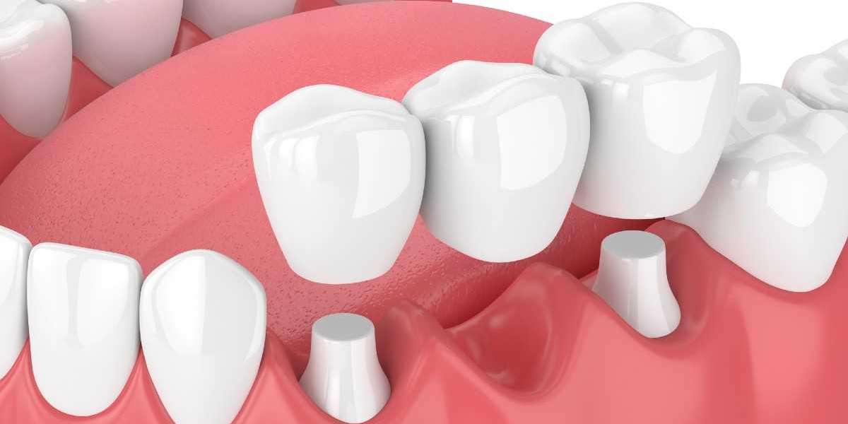 Unveiling the Affordable Dental Bridge Cost in Toronto: A Comprehensive Guide