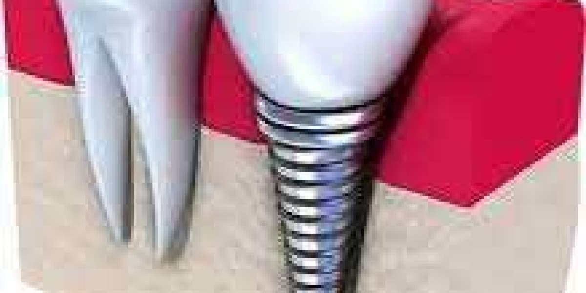 The Technique of Dental Implant Place