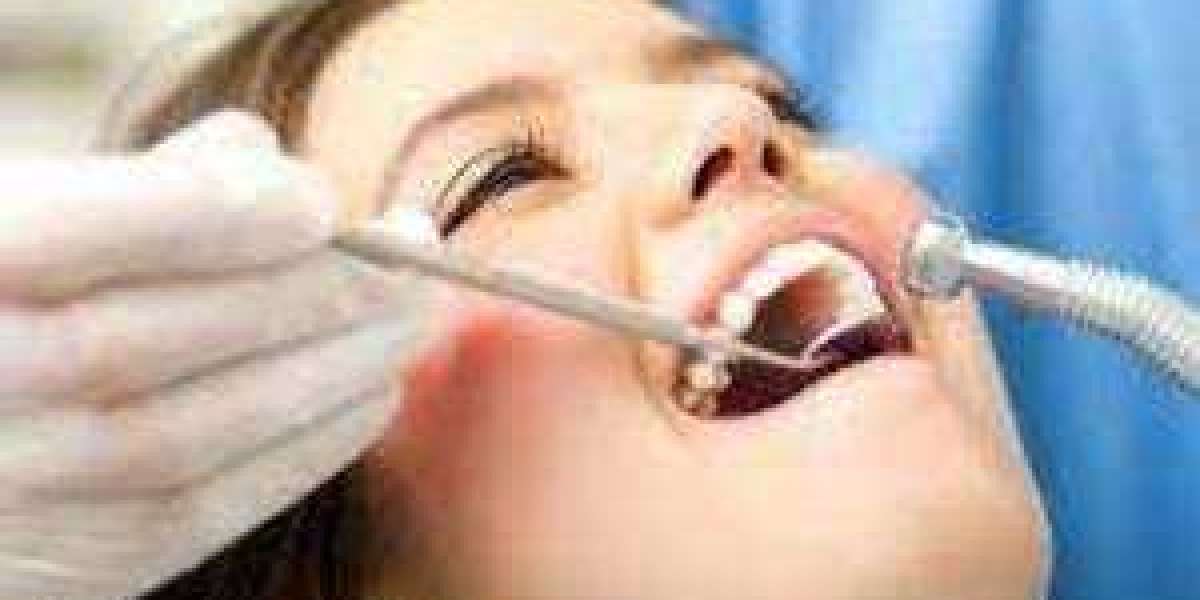 Navigating the Cost of Dental Bridges: Affordable Solutions for Your Smile