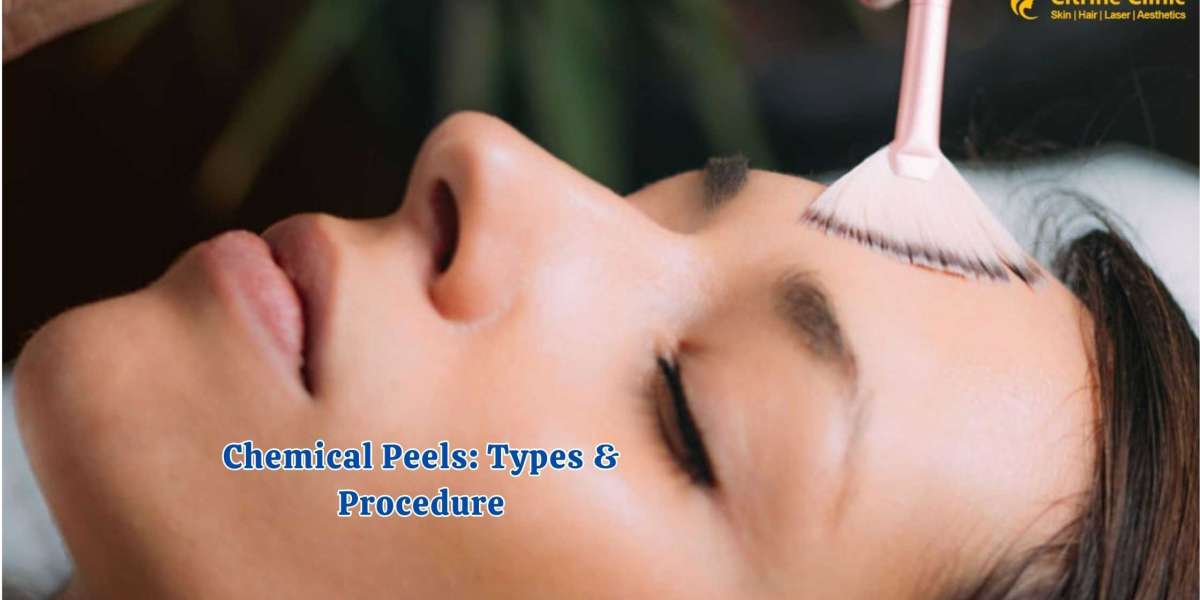Chemical Peels: Types & Procedure