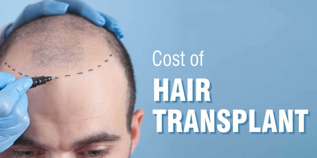 Can I Go for A Hair Transplant After 40?