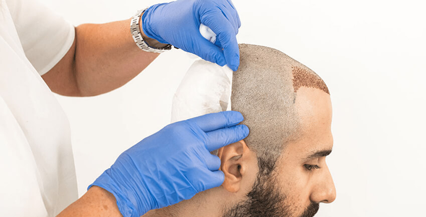 Is Hair Transplant Safe? Risks, Safety and Complications | TheAmberPost
