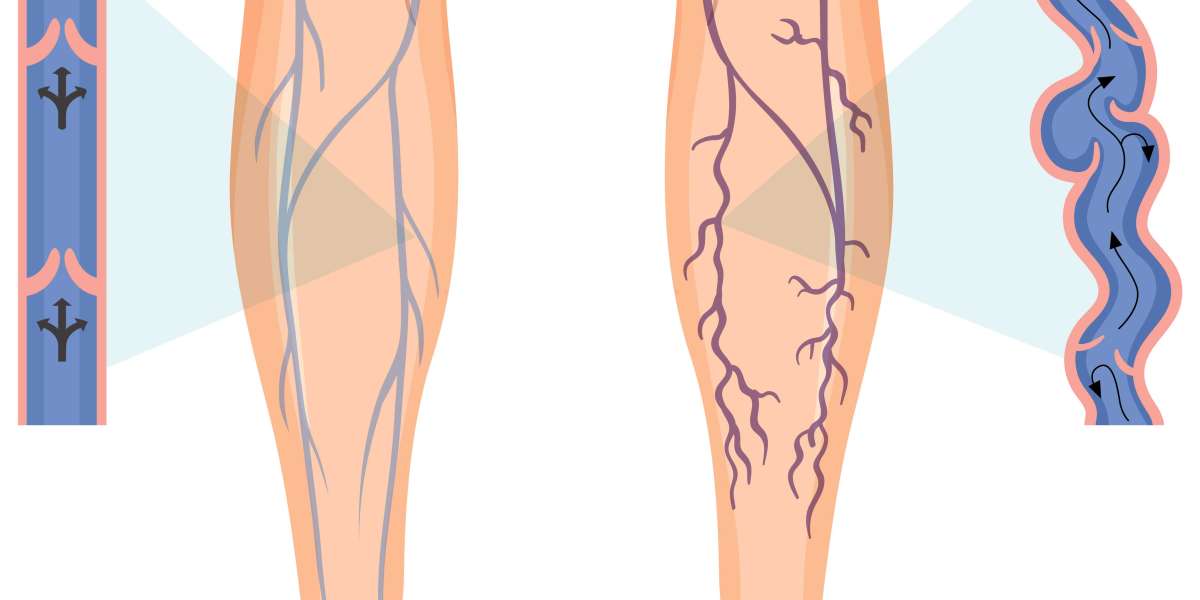 Affordable Varicose Veins Treatment Cost UK at Rejuvamed