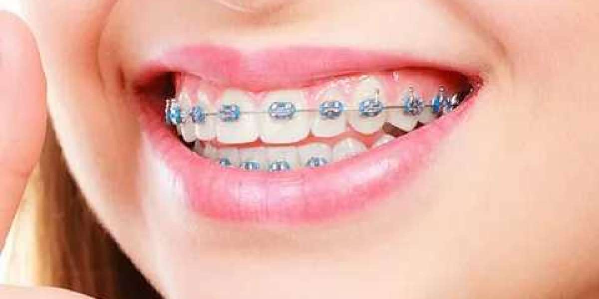 Choosing the Right Orthodontist: Key Considerations for Optimal Dental Treatment