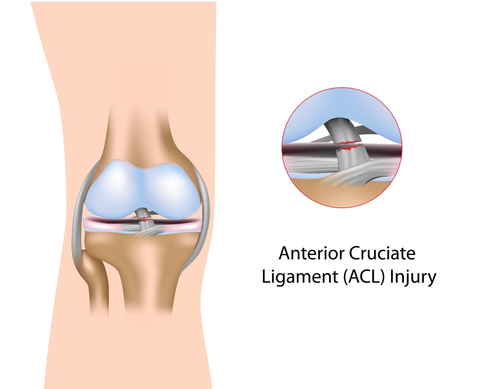 ACL Reconstruction Surgery & Recovery | Lancashire Clinic