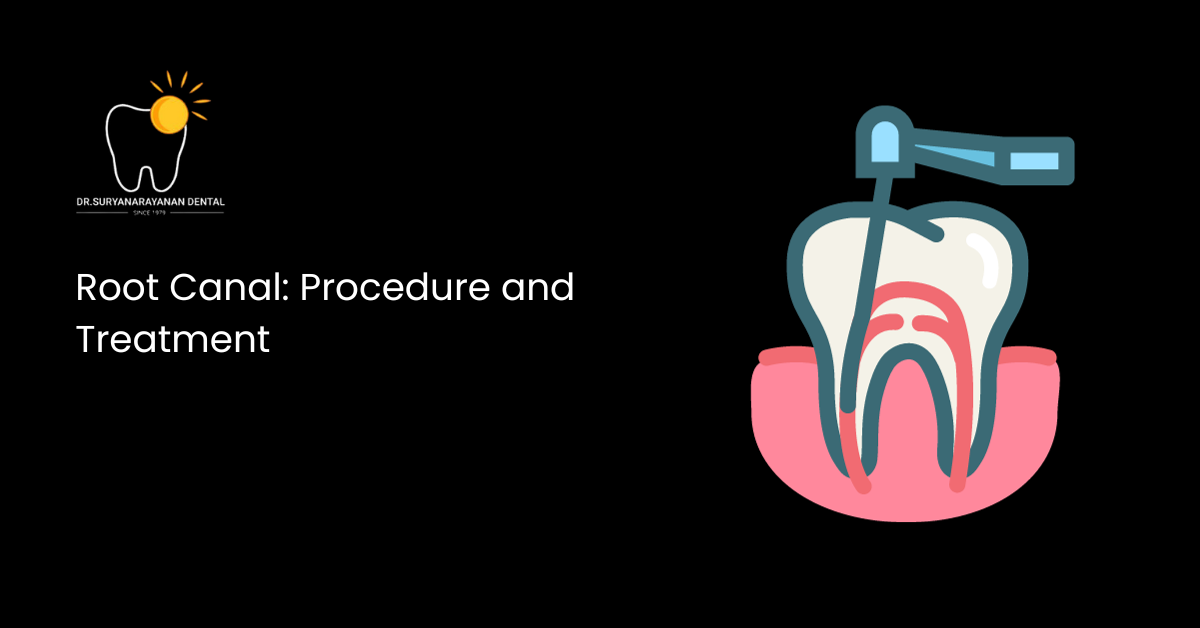 Root Canal: Procedure and Treatment | Dr. Suryanarayanan Dental Clinic