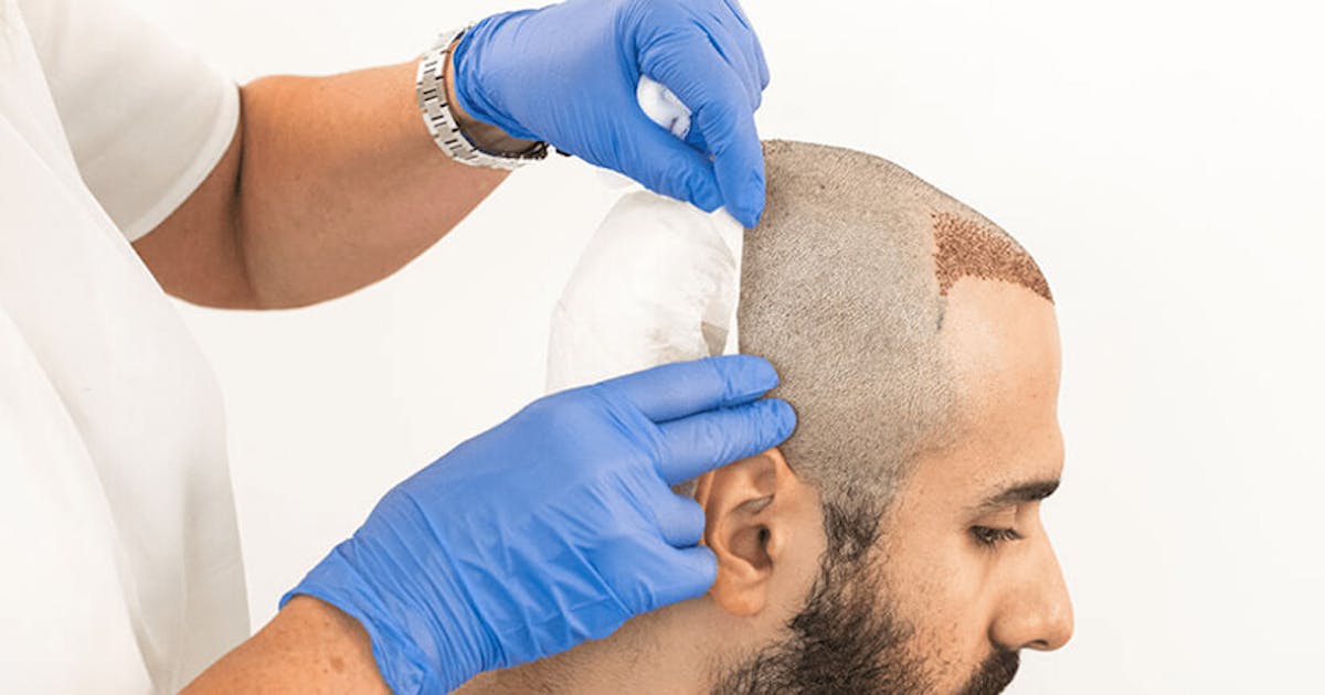 Hair Transplant Gone Wrong: Signs, Causes & Solutions