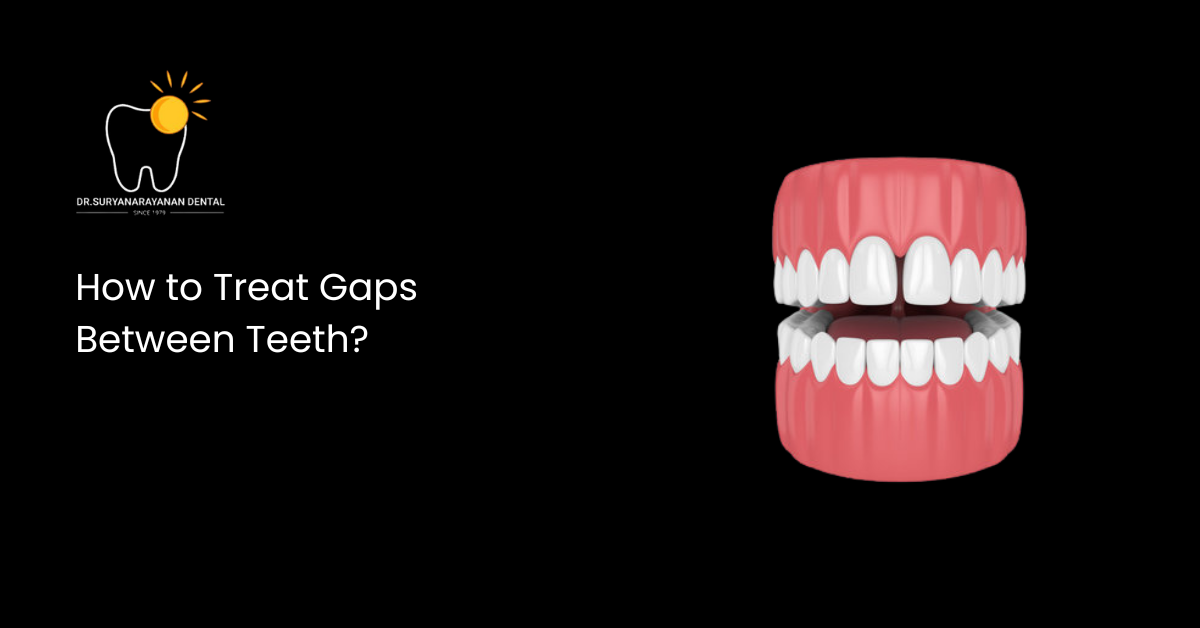 How to Treat Gaps Between Teeth? | Dr. Suryanarayanan Dental Clinic