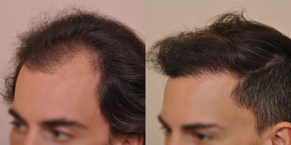 Unveiling the Transformation: FUE Hair Transplant in London - Databusinessonline.com