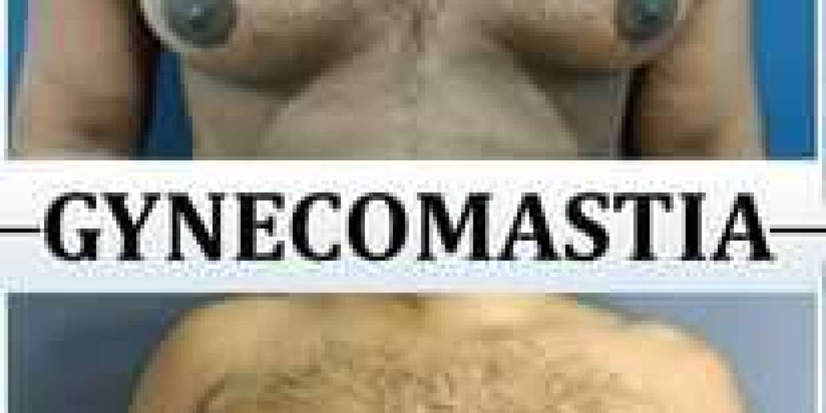 Difference Between True Gynecomastia and Pseudo-gynecomastia