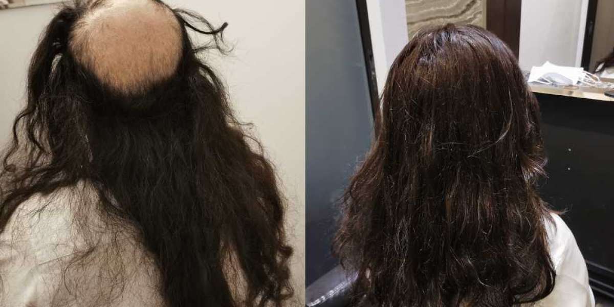 Cost of hair transplant singapore