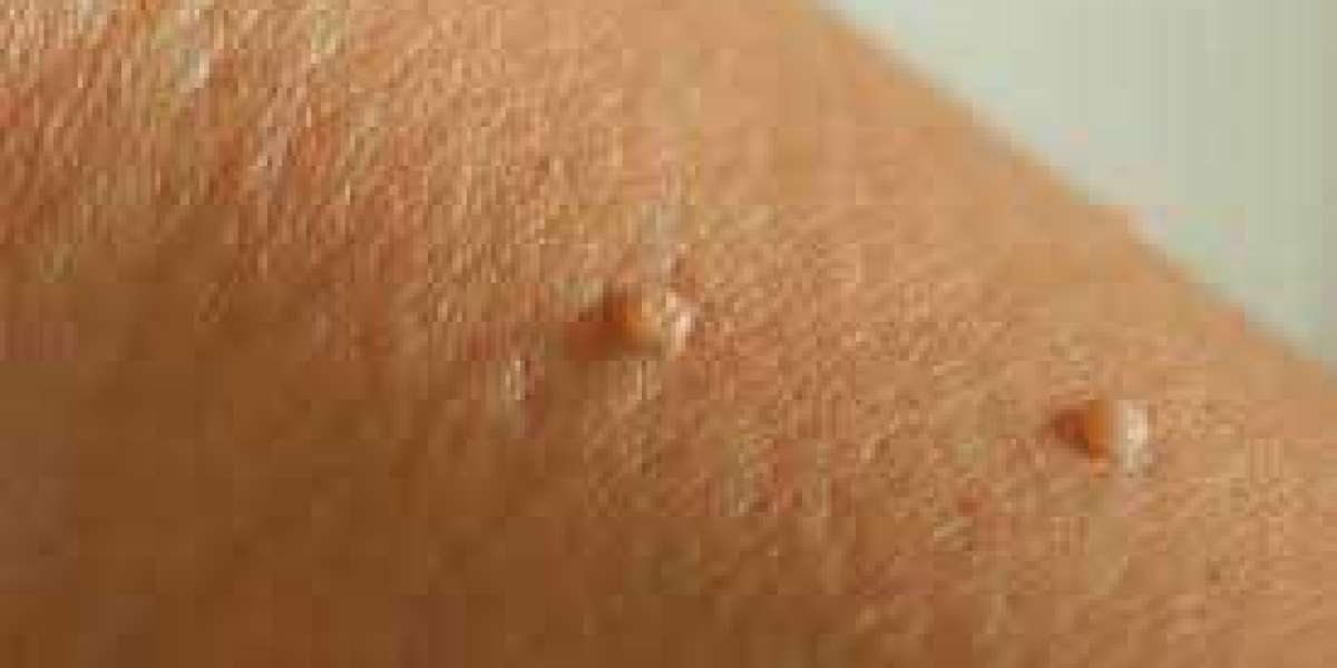 7 Disadvantages Of Defy Skin Tag Remover And How You Can Workaround It.
