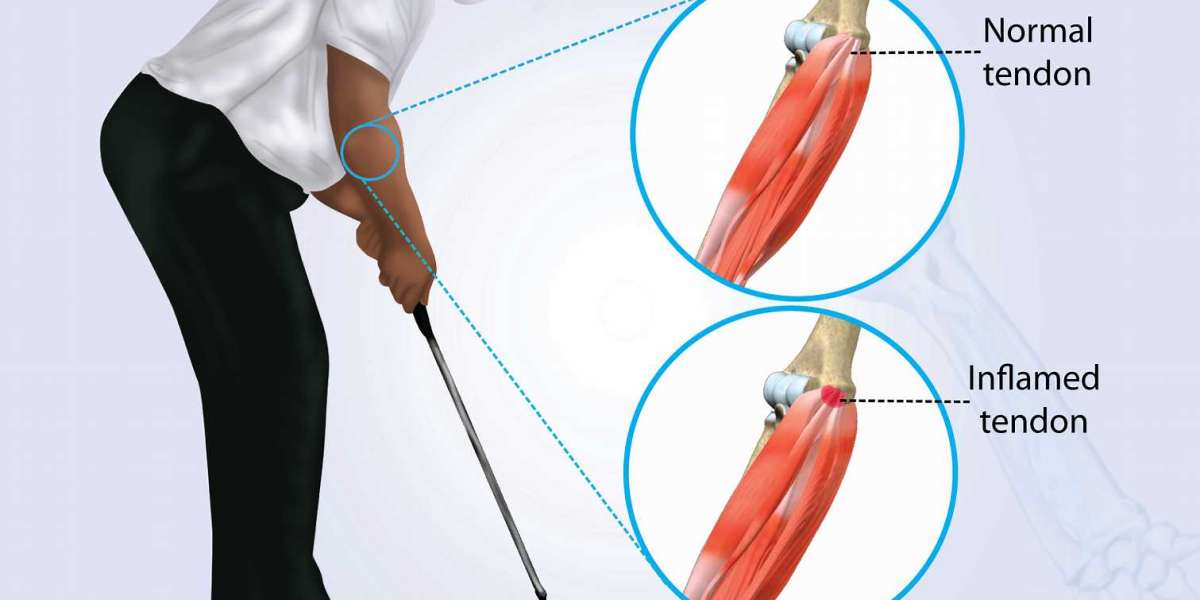 How Aspadol 200 Can Help with Golfer's Elbow Pain