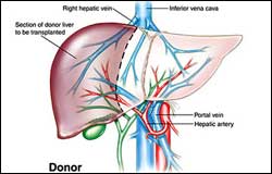 Liver donor, for Liver transplant surgeon in Delhi, India - Transplant liver India
