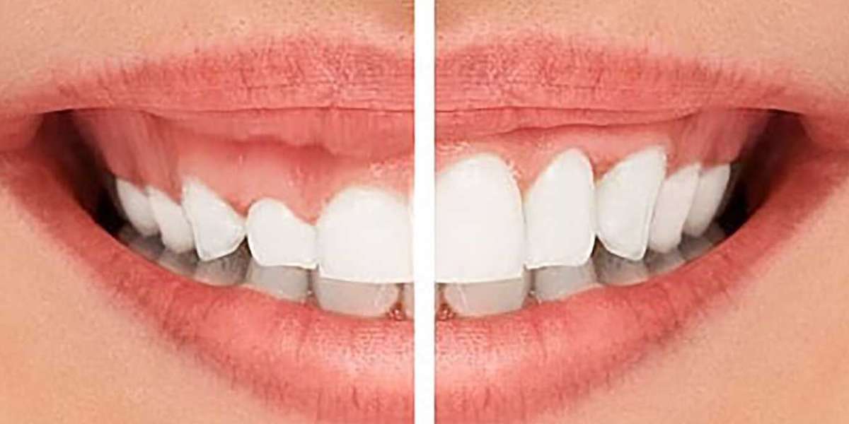 Transform Your Smile in Just One Day: The Ministry of Smile 1-Day Smile Makeover