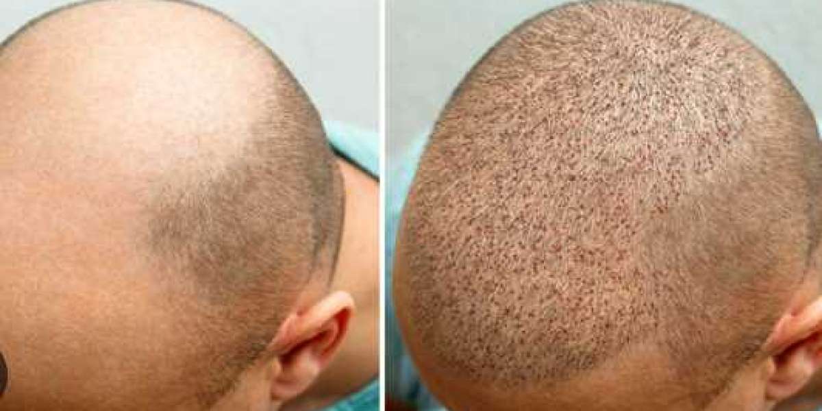 Best Hair Transplant in Aurangabad - Dr. Pranay Thakur